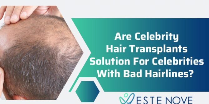 Are Celebrity Hair Transplants Solution For Celebrities