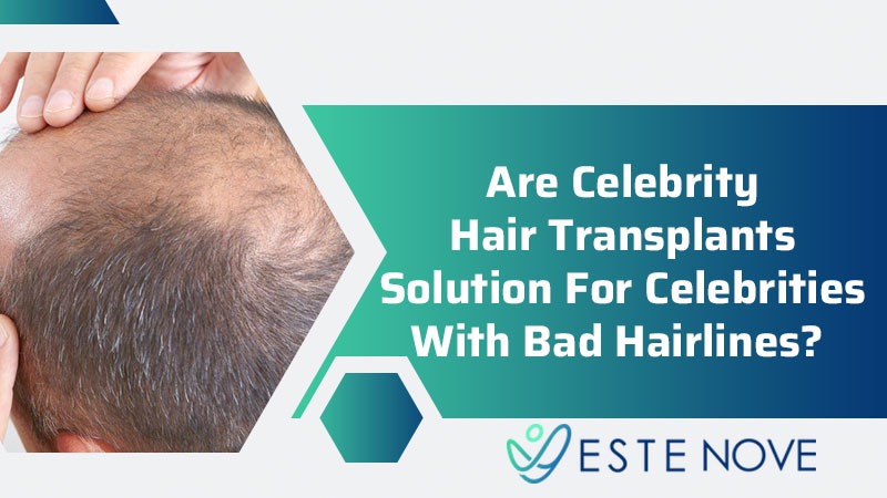 Are Celebrity Hair Transplants Solution For Celebrities