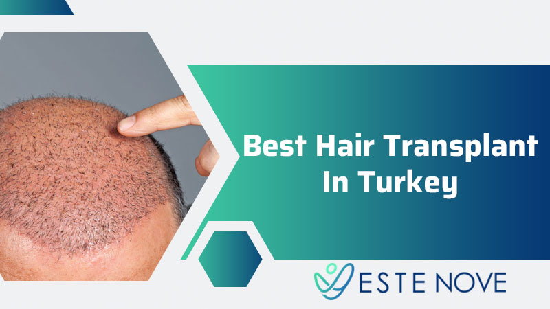Best Hair Transplant In Turkey