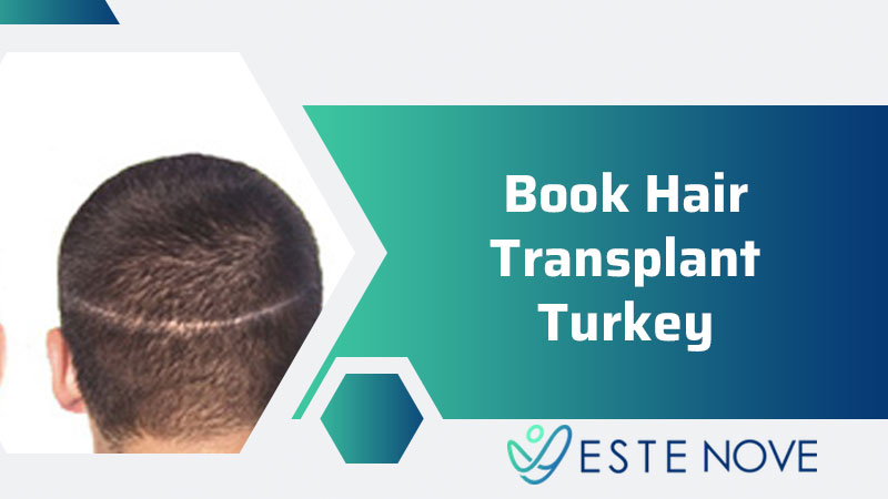 Book Hair Transplant Turkey