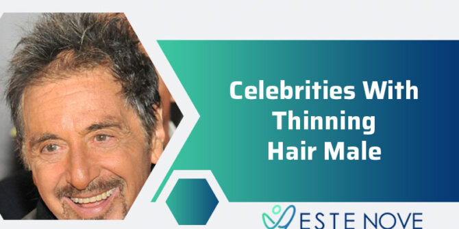 Celebrities With Thinning Hair Male