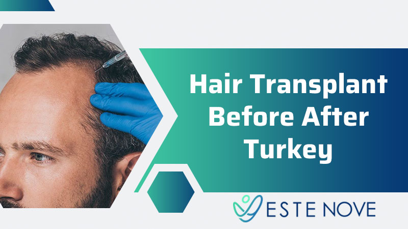 Hair Transplant Before After Turkey