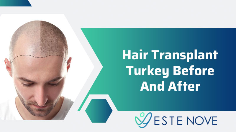 Best Hair Transplant Center in Turkey, Top 5 Hair Transplant Clinics in  Turkey