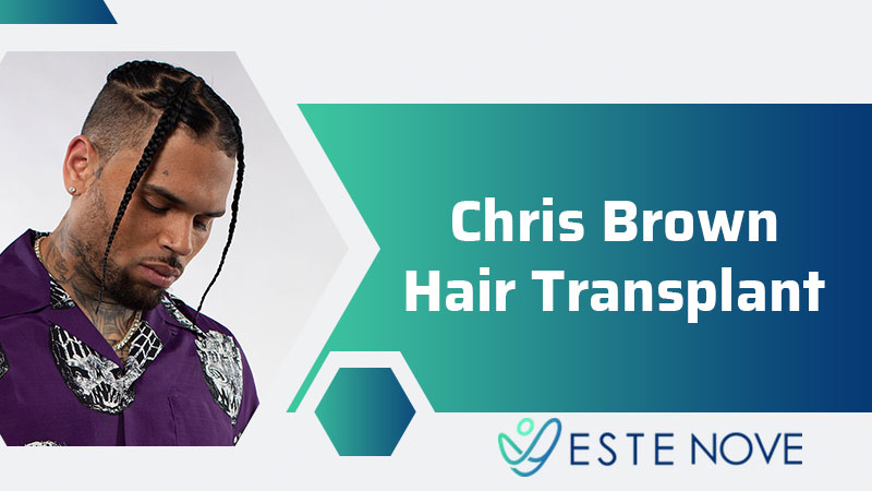 CHRIS BROWN HAIR TRANSPLANT