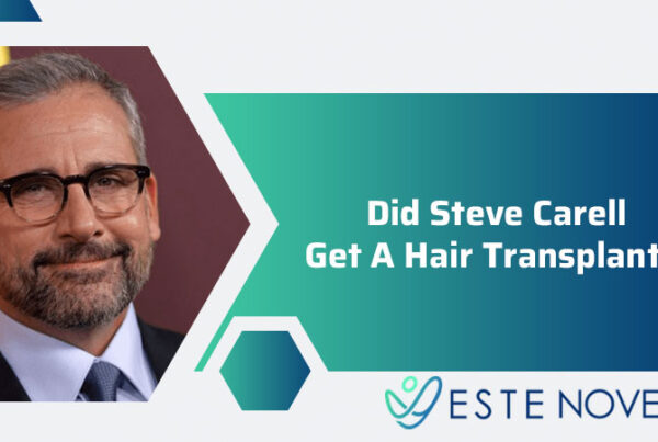 Did Steve Carell Get A Hair Transplant
