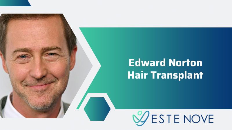Edward Norton Hair Transplant