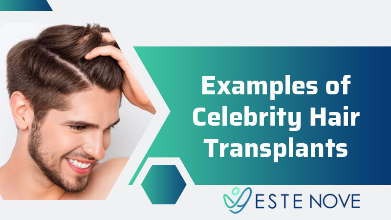 Examples of Celebrity Hair Transplants