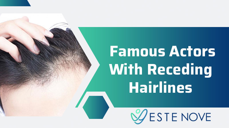 Famous Actors With Receding Hairlines