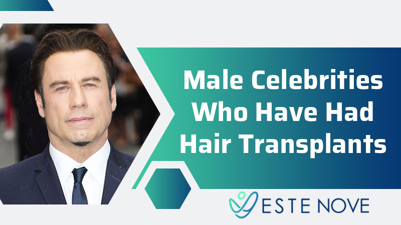 Male Celebrities Who Have Had Hair Transplants