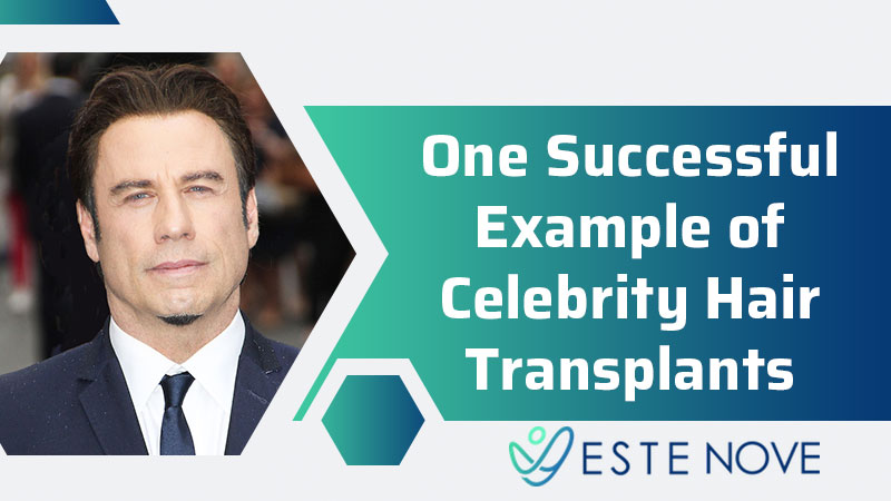 One Successful Example of Celebrity Hair Transplants