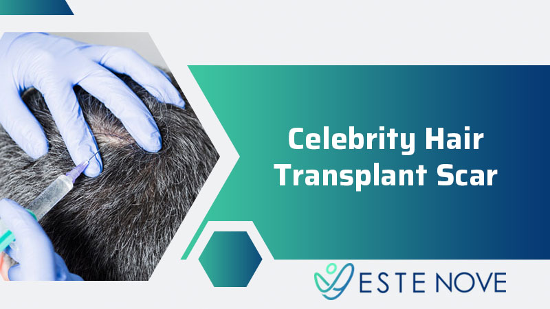 Celebrity Hair Transplant Scar