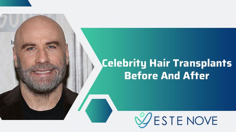 Celebrity Hair transplants Before and After