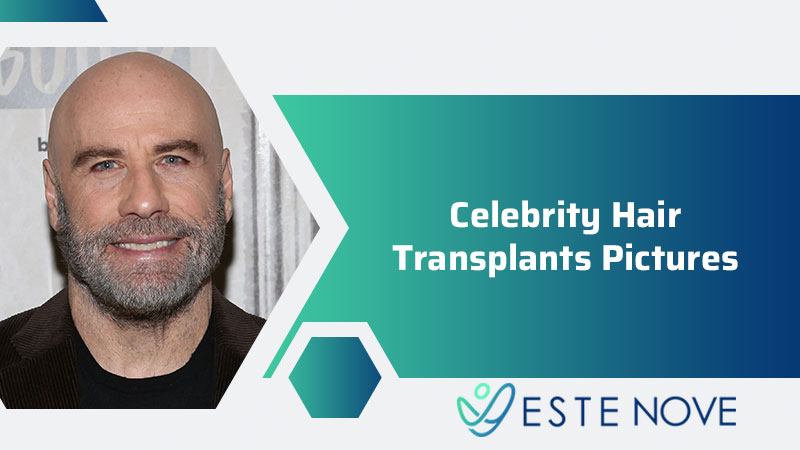 Celebrity Hair Transplants Pictures - Estenove Celebrity Hair Transplants Pictures - Estenove