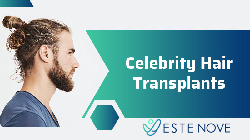 Celebrity Hair Transplants