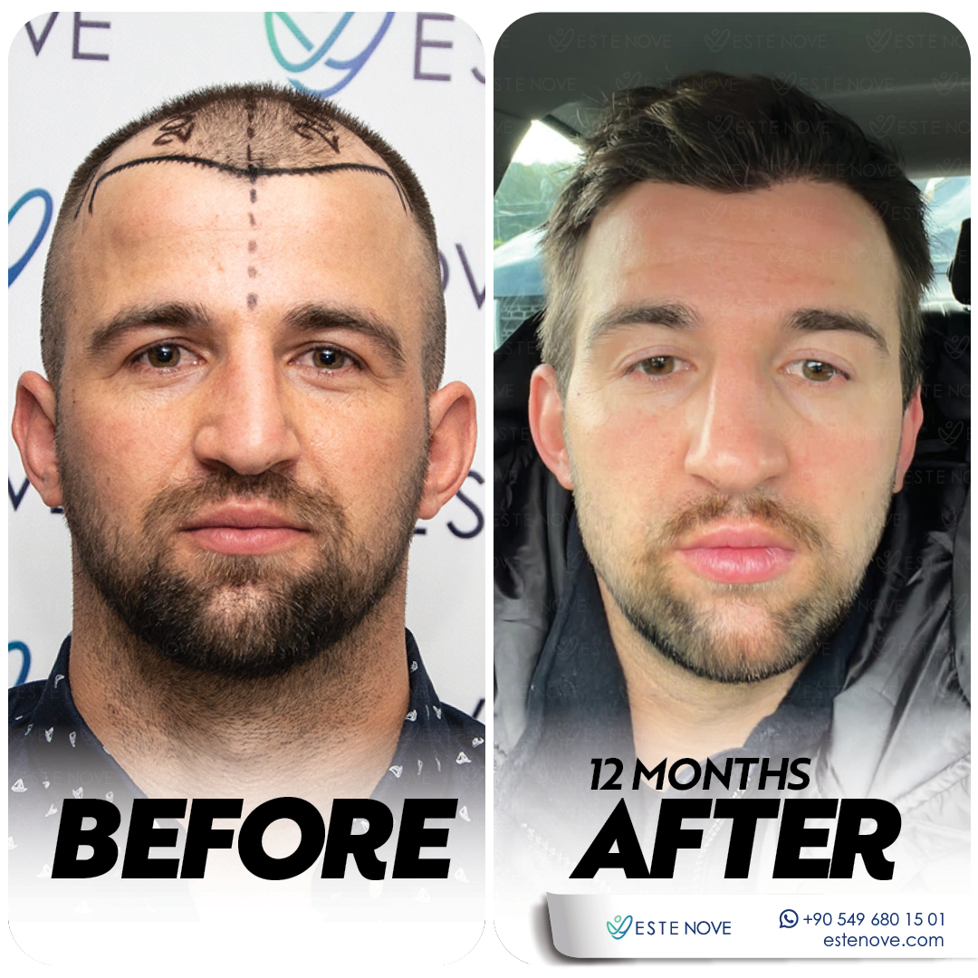 DHI Hair Transplant - Estenove DHI Hair Transplant - Estenove