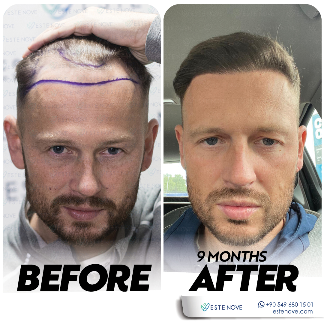 DHI Hair Transplant - Estenove DHI Hair Transplant - Estenove