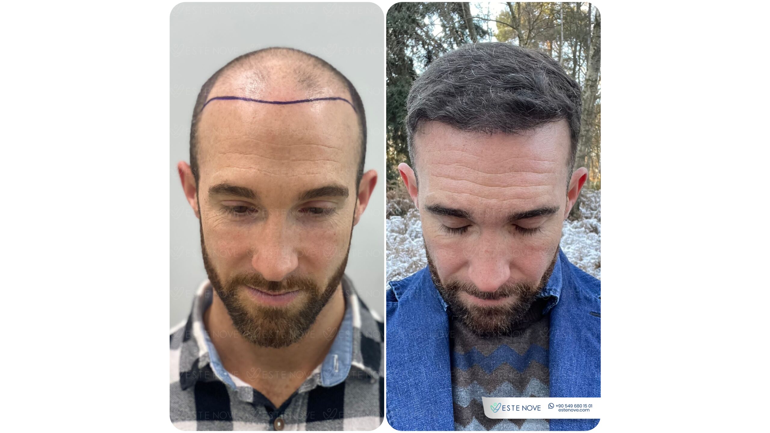 Transplanted Hair Growth Before & After