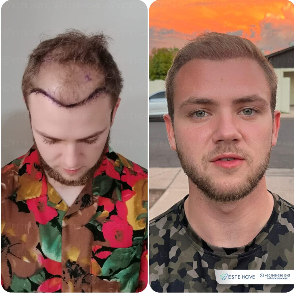 Receding hairline treatment