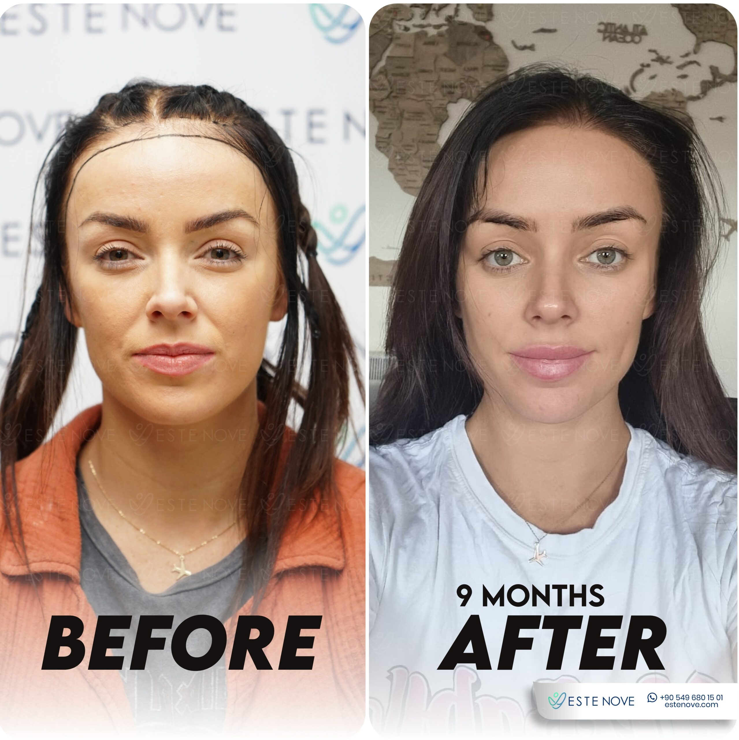Cheap hair transplant deals