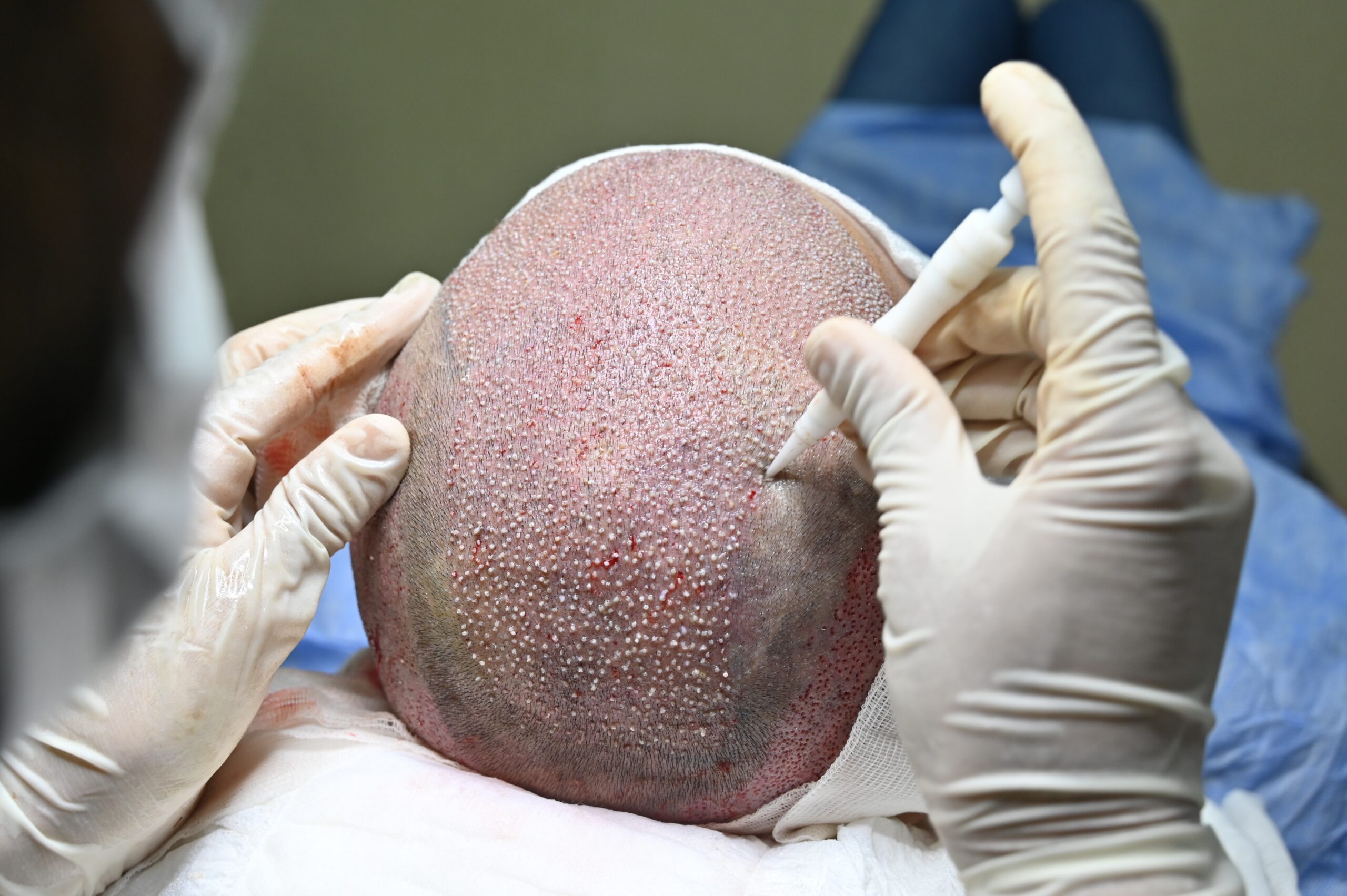 DHI Hair Transplant Method