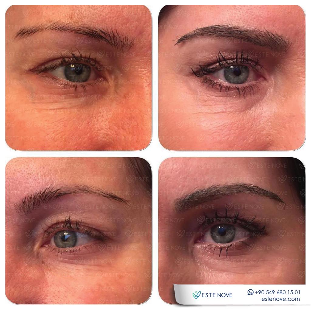 Female Eyebrow Transplantation Before and After
