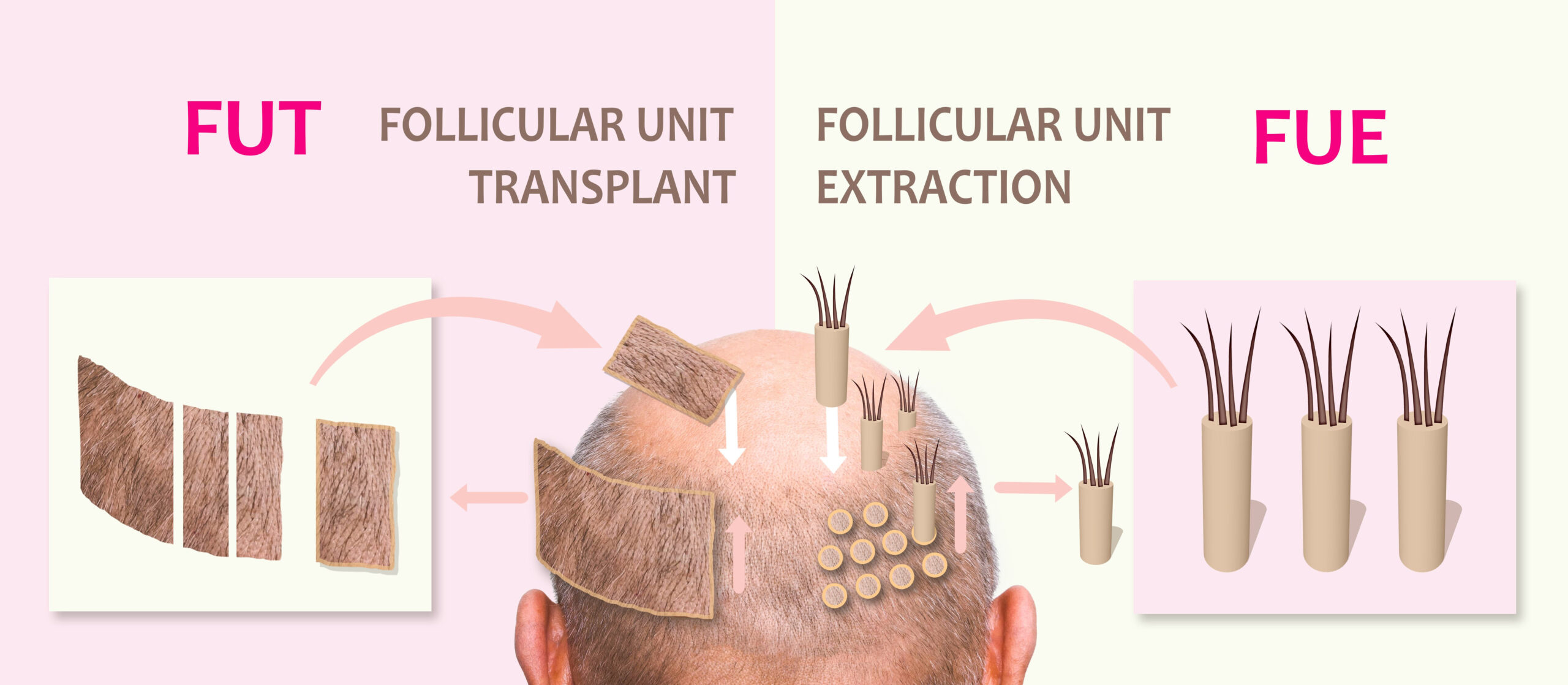 FUT vs FUE Hair Transplant