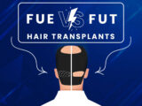 Diagram comparing the extraction methods of FUE and FUT hair transplant techniques.