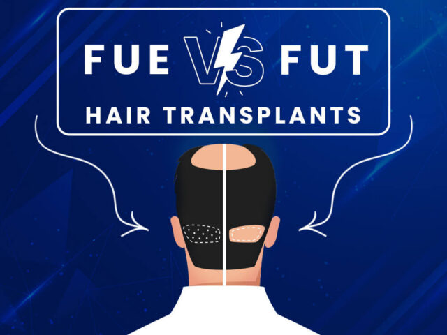 Diagram comparing the extraction methods of FUE and FUT hair transplant techniques.
