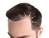 Demonstration of receding hairline from temples