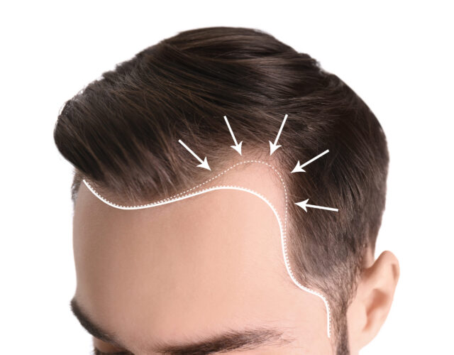 Demonstration of receding hairline from temples