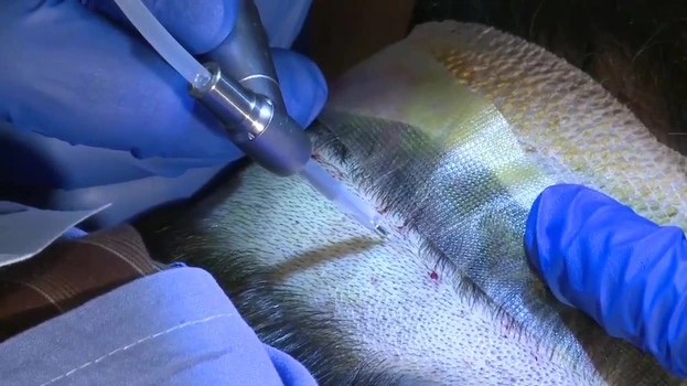 Neograft Application in Hair Transplant -2