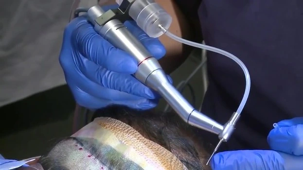 Neograft Application in Hair Transplant