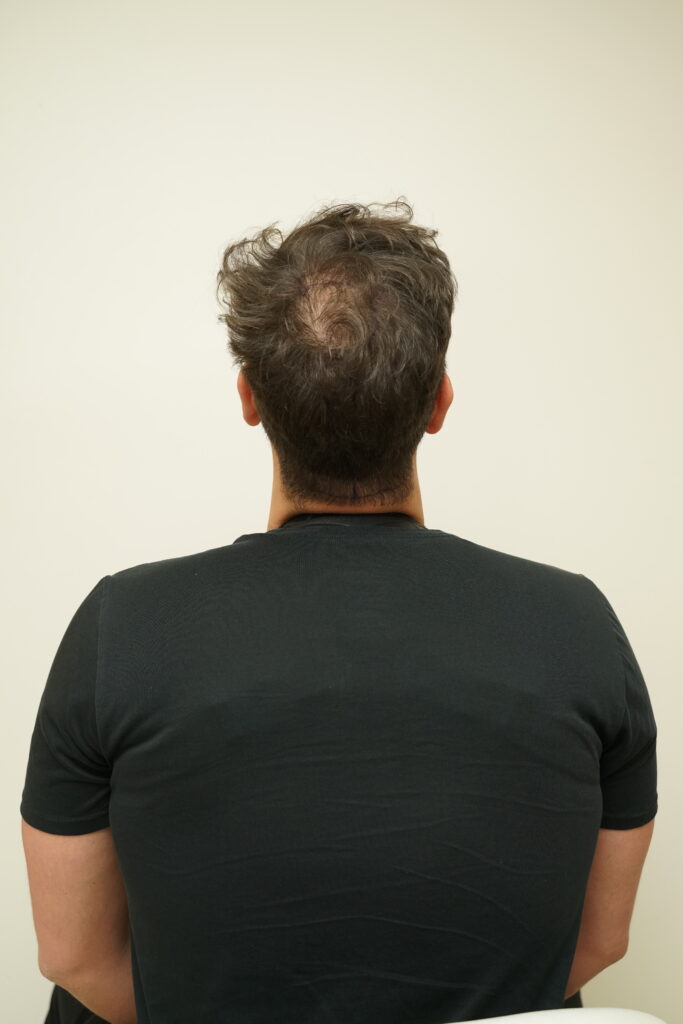 Men Crown Hair Thinning Example