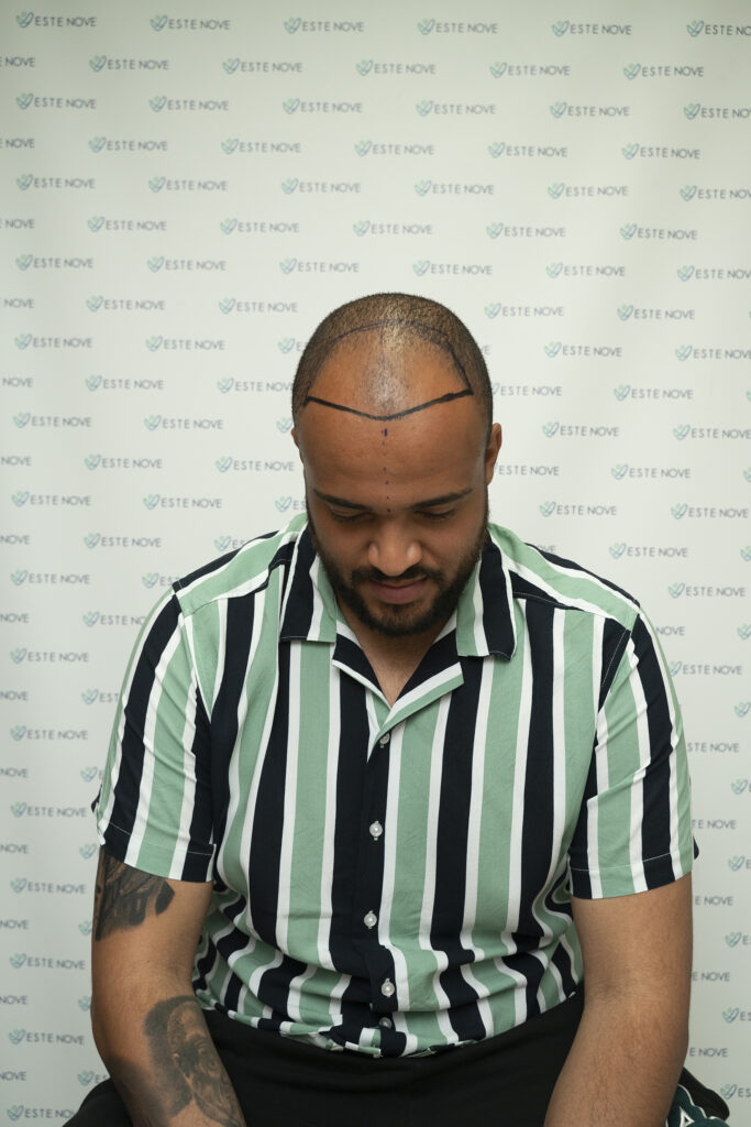 Male Pattern Baldness