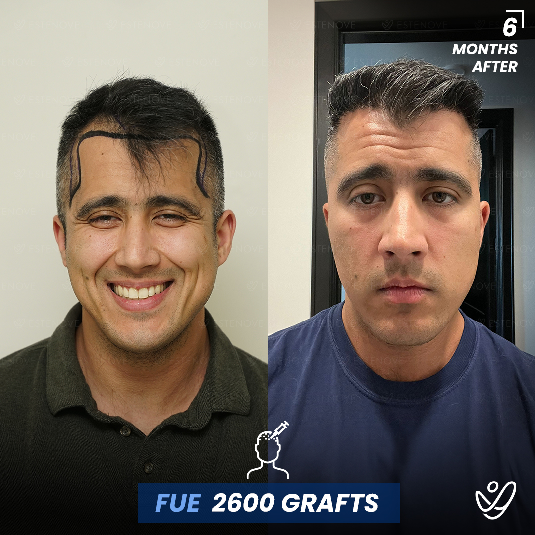 FUE Hair Transplant Male 2600 Grafts Before and After