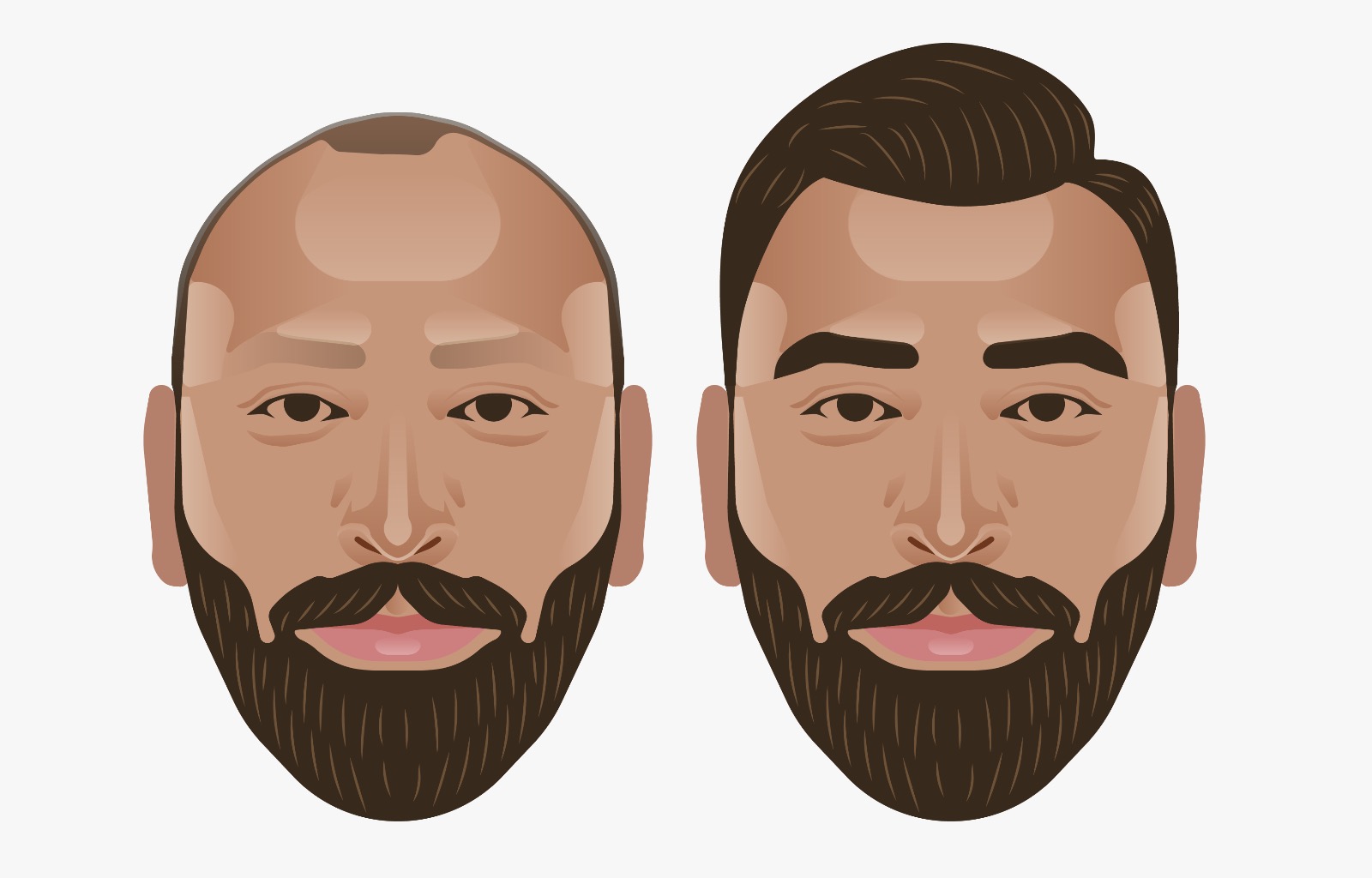 Unshaven Hair Transplant Explained Estenove unshaven-hair-transplant-explained-estenove