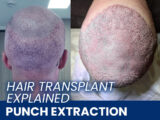 A scalp right after a hair transplant done by punch extraction method