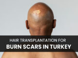 Bald man with burn scar in his head and text saying Hair Transplantation for Burn Scars in Turkey