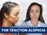 Female with a hair transplant and text says Hair transplantation for traction alopecia