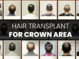 Text saying hair transplant for crown area with bald men photos