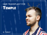 text saying hair transplant for temple with man picture with receding hairline