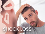 Shock hair loss