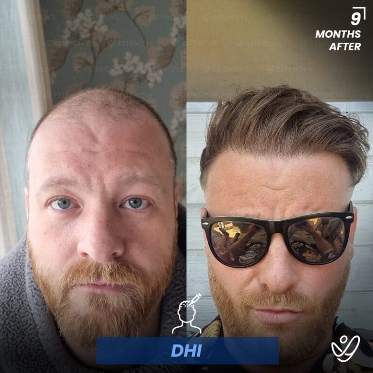 Male DHI 9 Months Before&After