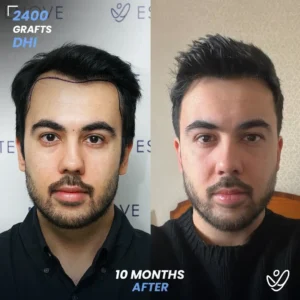 2400 graft DHI 10 months before & after hair transplant