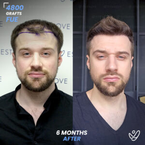 Male FUE 4800 Grafts 6 Months Before&After