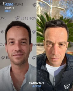 4200 graft 9 months Before & After Hair transplant DHI
