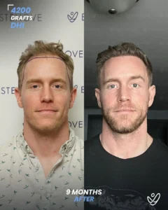 4200 graft DHI 9 months before & after hair transplant