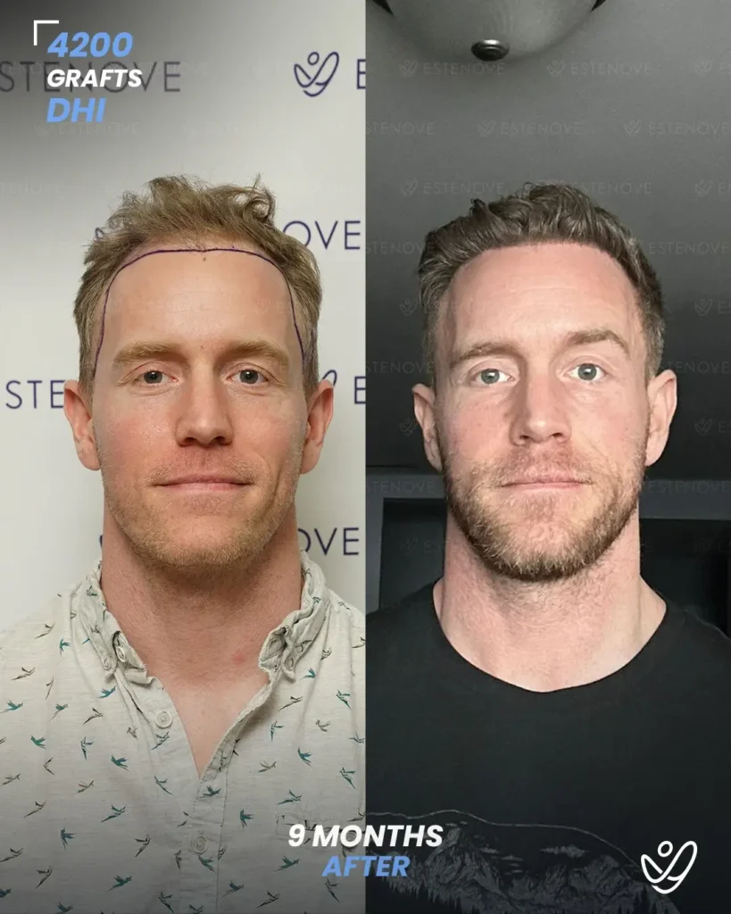4200 graft DHI 9 months before & after hair transplant 4200 graft DHI 9 months before & after hair transplant