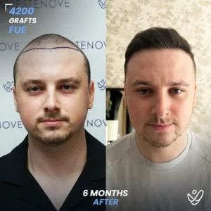 4200 graft FUE 6 months before & after hair transplant