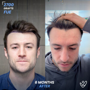 Male FUE 2700 Grafts 6 Months Before&After